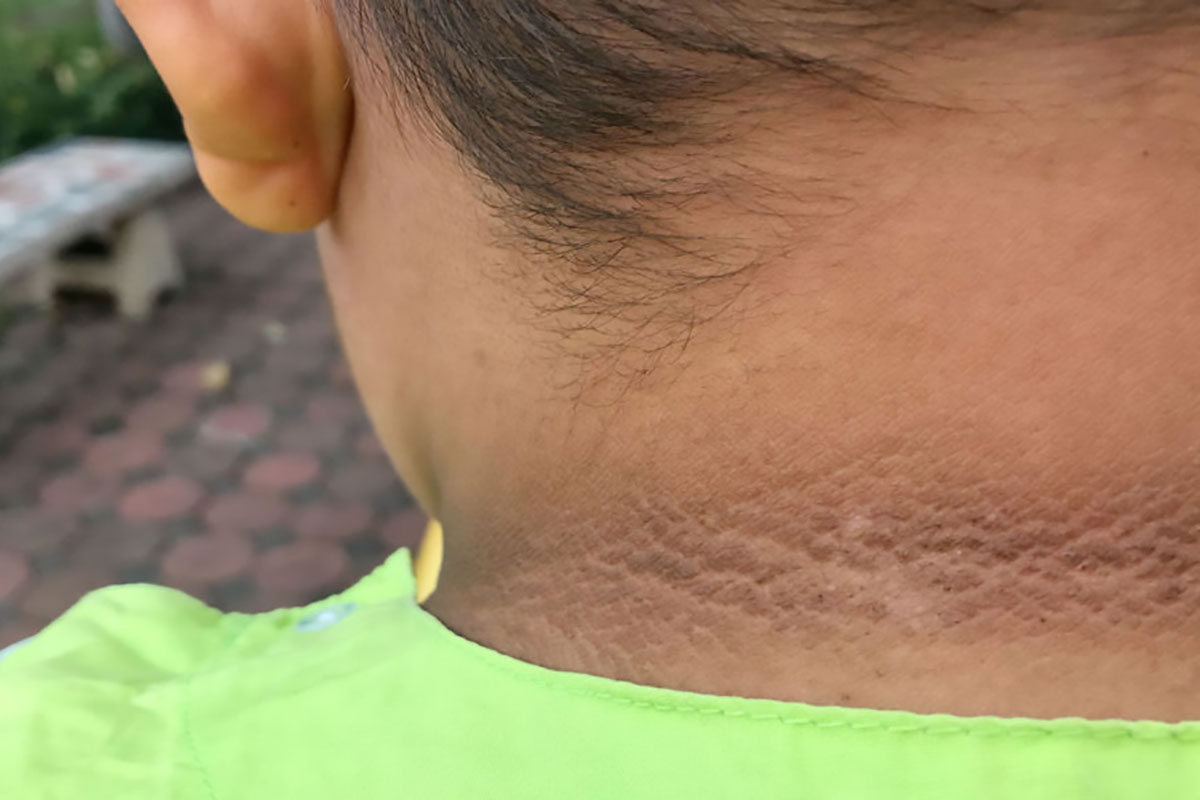 Acantose Nigricans: Tudo o que Você Precisa Saber para Identificar e Tratar a Condição de Forma Eficaz